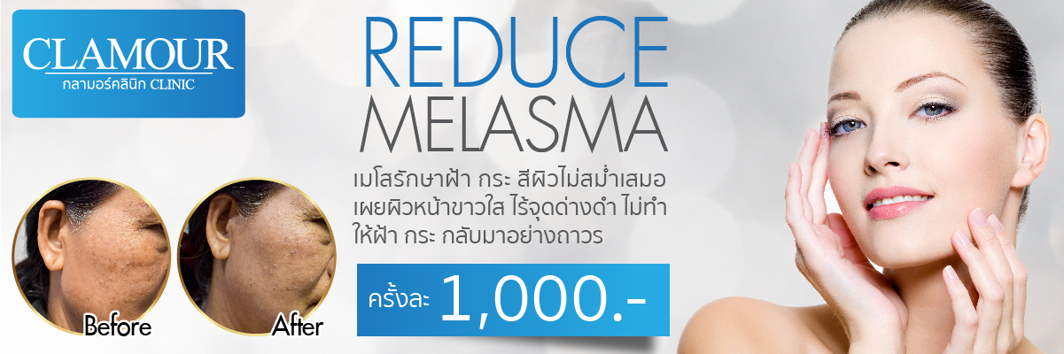 Reduce Melasma